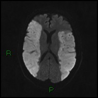 File:Bilateral acute middle cerebral artery territory infarcts (Radiopaedia 77319-89402 Axial DWI 38).jpg