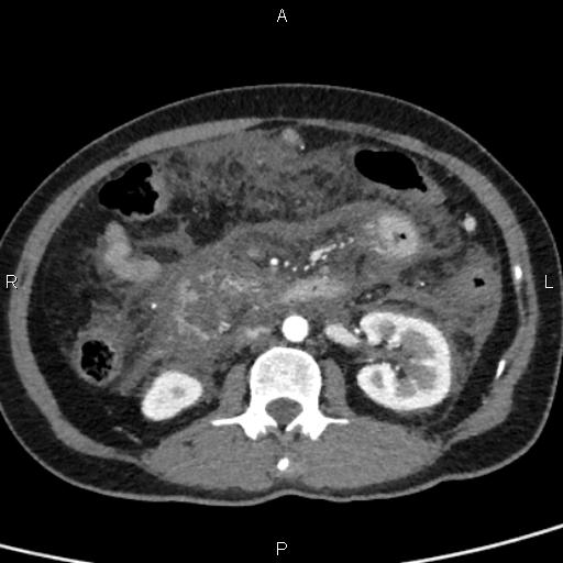 Bilateral adrenal gland hyperenhancement in pancreatitis (Radiopaedia 86642-102753 B 66).jpg