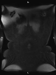 Bilateral adrenal myelolipoma (Radiopaedia 63058-71537 Coronal T1 fat sat 2).jpg