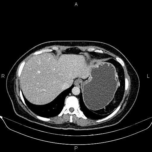 Bilateral benign adrenal adenomas (Radiopaedia 86912-103124 B 19).jpg