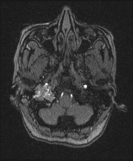Bilateral carotid body tumors and right glomus jugulare tumor (Radiopaedia 20024-20060 Axial MRA 24).jpg