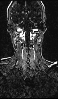 Bilateral carotid body tumors and right glomus jugulare tumor (Radiopaedia 20024-20060 MRA 124).jpg