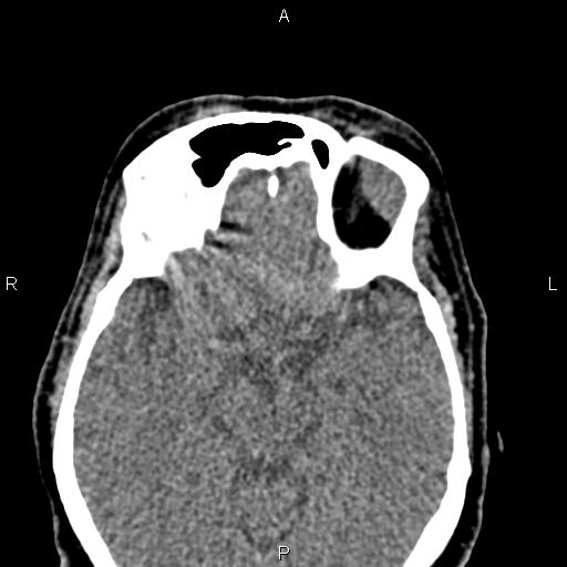 File:Bilateral enlargement of lacrimal glands - sarcoidosis (Radiopaedia 62627-70921 Axial non-contrast 63).jpg