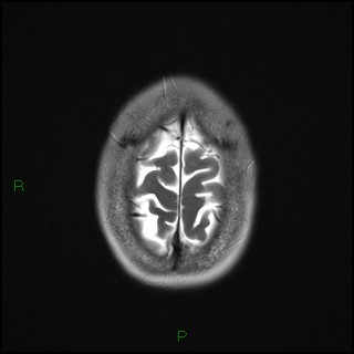 File:Bilateral frontal mucoceles (Radiopaedia 82352-96455 Axial T2 20).jpg