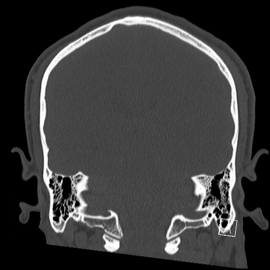 Bilateral occipital condyle fracture (type 2) (Radiopaedia 87675-104089 Coronal bone window 88).jpg