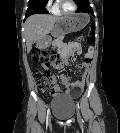 File:Bilateral ovarian mature cystic teratomas (Radiopaedia 79373-92457 B 16).jpg