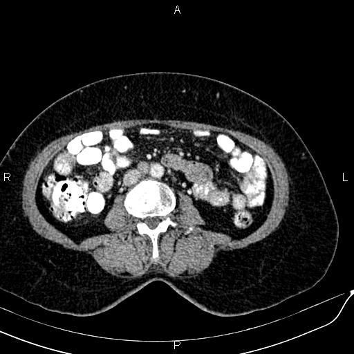 Bilateral ovarian serous cystadenocarcinoma (Radiopaedia 86062-101989 B 55).jpg