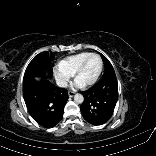 Bilateral ovarian serous cystadenocarcinoma (Radiopaedia 86062-101989 B 9).jpg