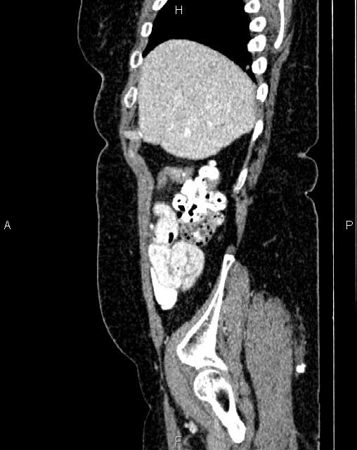 Bilateral ovarian serous cystadenocarcinoma (Radiopaedia 86062-101989 E 10).jpg