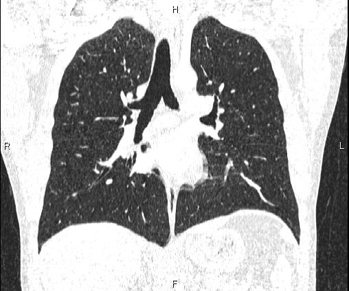 Bilateral pulmonary AVM (Radiopaedia 83134-97505 Coronal lung window 46).jpg