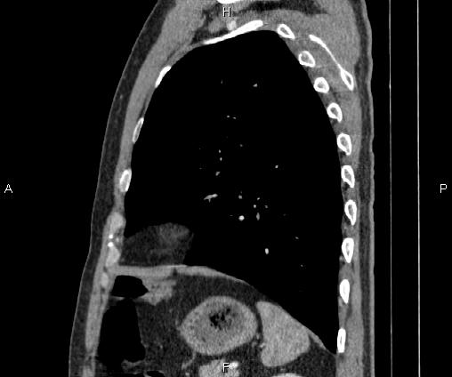 Bilateral pulmonary AVM (Radiopaedia 83134-97505 D 85).jpg
