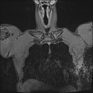 File:Bilateral spinoglenoid notch ganglion cysts (Radiopaedia 29577-30082 Coronal STIR 4).jpg