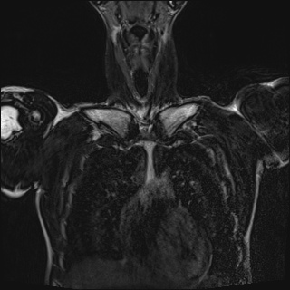 File:Bilateral spinoglenoid notch ganglion cysts (Radiopaedia 29577-30082 Coronal T2 29).jpg