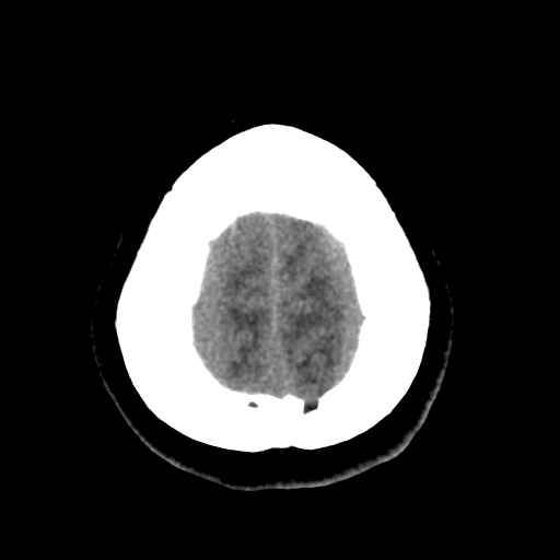 Bilateral subacute subdural hematoma (Radiopaedia 69240-79018 Axial non-contrast 46).jpg