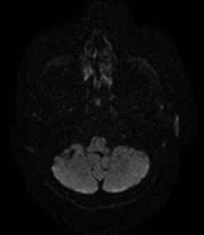 File:Bilateral thalamic glioma (Radiopaedia 65852-75009 Axial DWI 3).jpg