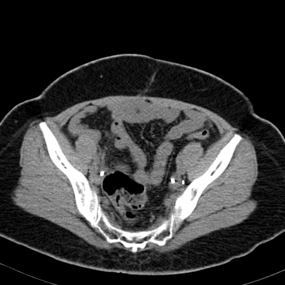 Bilateral ureteric stents (Radiopaedia 48795-53825 Axial non-contrast 52).jpg