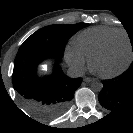 File:Bile leak from liver traumatic laceration (Radiopaedia 63463-72077 Axial Biliscopin 1).jpg