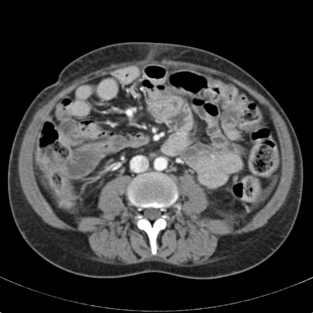 Biliary necrosis - liver transplant (Radiopaedia 21876-21846 B 42).jpg