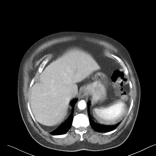 File:Bladder papillary urothelial carcinoma (Radiopaedia 48119-52951 A 4).png
