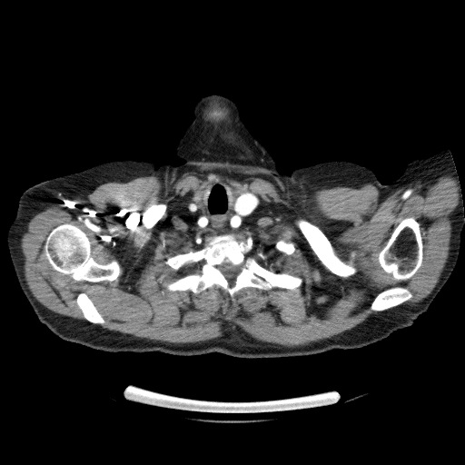 Bladder tumor detected on trauma CT (Radiopaedia 51809-57609 A 10).jpg