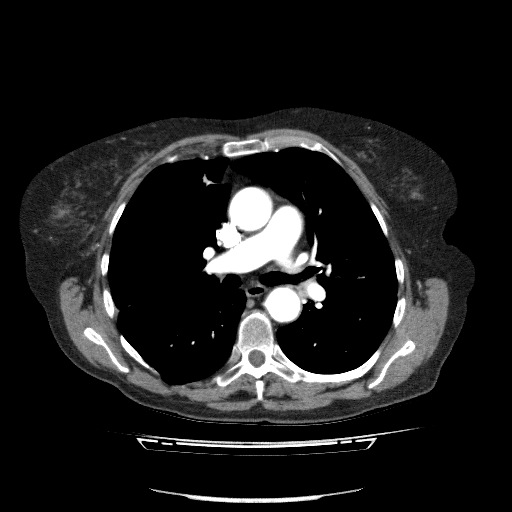 Bladder tumor detected on trauma CT (Radiopaedia 51809-57609 A 46).jpg
