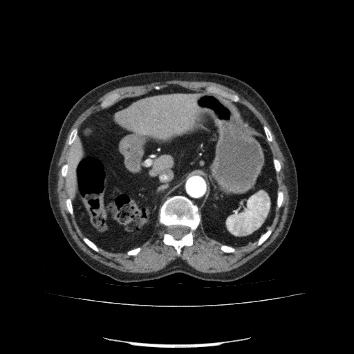 File:Bladder tumor detected on trauma CT (Radiopaedia 51809-57609 A 87).jpg