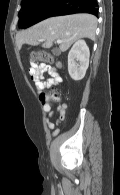 Bleeding duodenal ulcer and adenomyomatosis of gallbladder (Radiopaedia 61834-69861 C 26).jpg