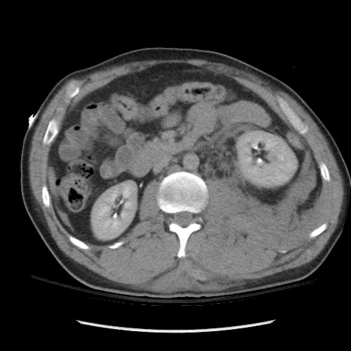 Blunt abdominal trauma with solid organ and musculoskelatal injury with active extravasation (Radiopaedia 68364-77895 Axial C+ delayed 60).jpg