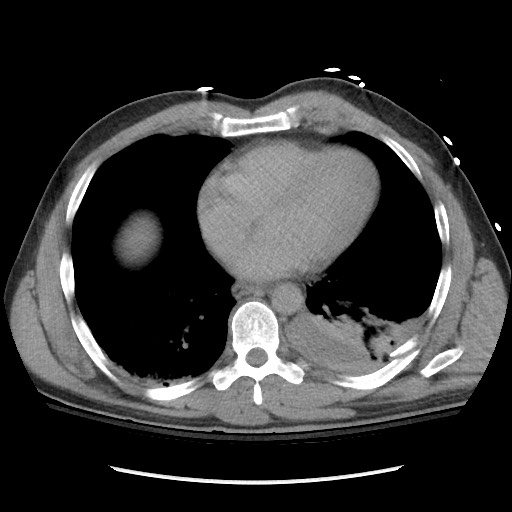 Blunt abdominal trauma with solid organ and musculoskelatal injury with active extravasation (Radiopaedia 68364-77895 Axial C+ delayed 7).jpg