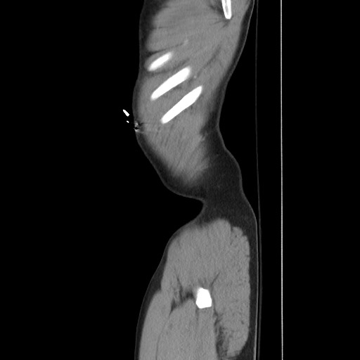 Blunt abdominal trauma with solid organ and musculoskelatal injury with active extravasation (Radiopaedia 68364-77895 C 19).jpg