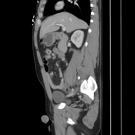Blunt abdominal trauma with solid organ and musculoskelatal injury with active extravasation (Radiopaedia 68364-77895 C 60).jpg