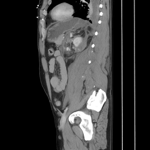 Blunt abdominal trauma with solid organ and musculoskelatal injury with active extravasation (Radiopaedia 68364-77895 C 98).jpg
