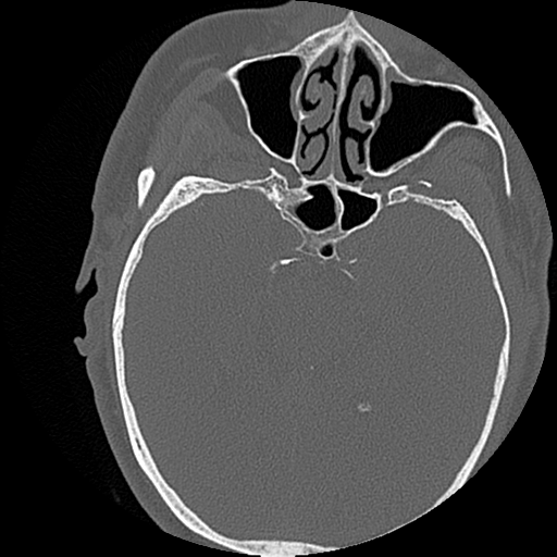 File:Blunt cerebrovascular injury (Radiopaedia 53682-59743 Axial bone window 1).png