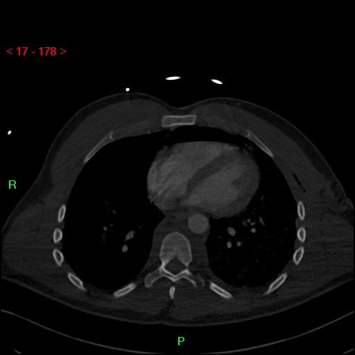 Blunt thoracic trauma (Radiopaedia 73454-84221 Axial bone window 68).jpg