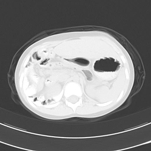 File:Bochdalek diaphragmatic hernia (Radiopaedia 38866-41059 Axial lung window 26).jpg