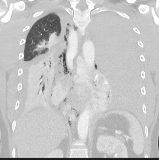 Boerhaave syndrome (Radiopaedia 39382-41661 Coronal lung window 32).png