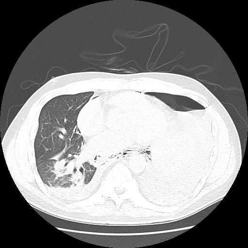 Boerhaave syndrome (Radiopaedia 59796-67310 Axial lung window 40).jpg