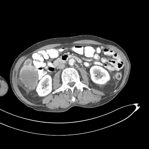 Bone metastasis from squamous cell carcinoma (Radiopaedia 30133-30730 B 35).jpg