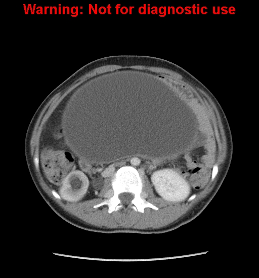 Borderline mucinous cystadenoma of ovary (Radiopaedia 25586-25767 A 16).jpg