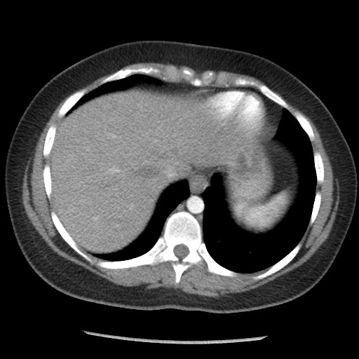 File:Borderline mucinous tumor (ovary) (Radiopaedia 78228-90808 A 37).jpg