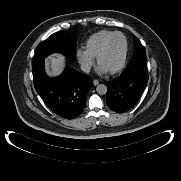 Bosniak renal cyst - type IV (Radiopaedia 24244-24518 Axial non-contrast 4).jpg