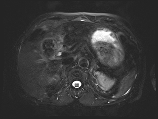 File:Bouveret syndrome (Radiopaedia 61017-68856 Axial MRCP 19).jpg