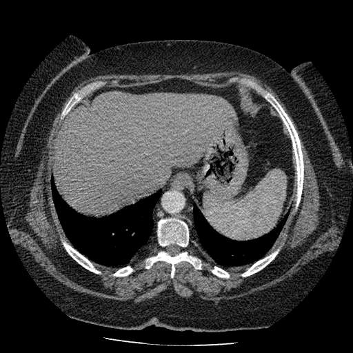 Bovine aortic arch - right internal mammary vein drains into the superior vena cava (Radiopaedia 63296-71875 A 141).jpg