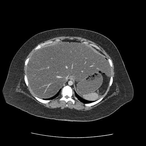 Bowel and splenic infarcts in acute lymphocytic leukemia (Radiopaedia 61055-68915 A 27).jpg