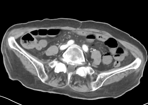 File:Bowel ischemia (Radiopaedia 58273-65382 A 39).png