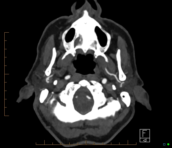 Brachiocephalic trunk stenosis (Radiopaedia 87242-103519 A 65).jpg