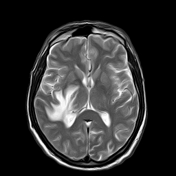 File:Brain abscess complicated by intraventricular rupture and ventriculitis (Radiopaedia 82434-96571 Axial T2 13).jpg