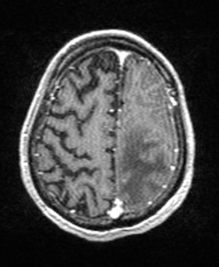 Brain abscess with dual rim sign (Radiopaedia 87566-103938 Axial T1 C+ 130).jpg