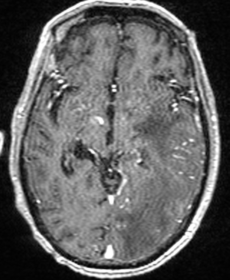 Brain abscess with dual rim sign (Radiopaedia 87566-103938 Axial T1 C+ 77).jpg