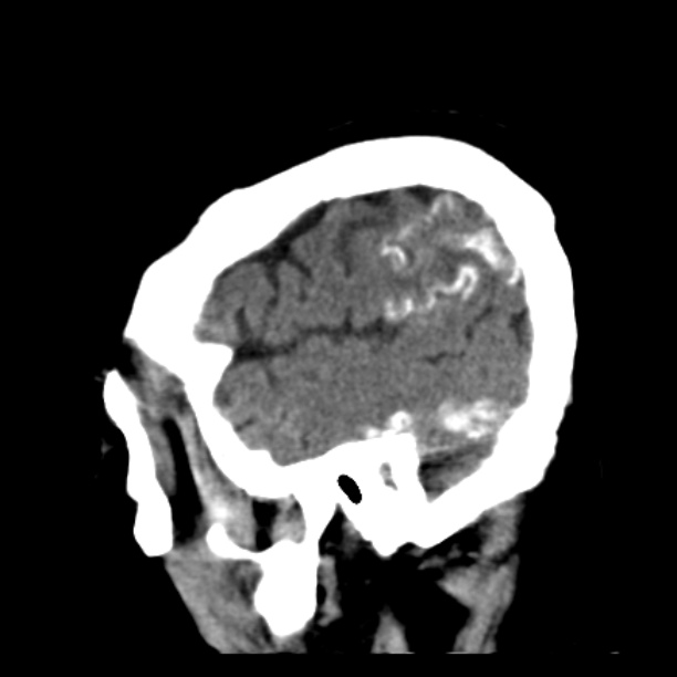 Brain cortical laminar necrosis (Radiopaedia 25822-25971 non-contrast 42).jpg